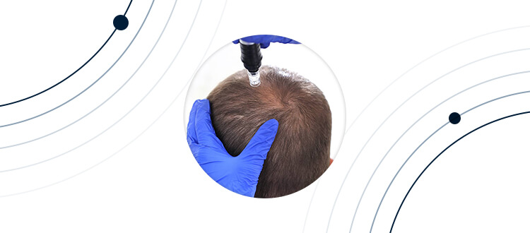 SAÇ MEZOTERAPİSİ SAÇ MEZOTERAPİSİ